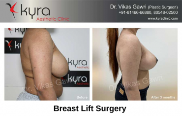 breast-lift-surgery-2
