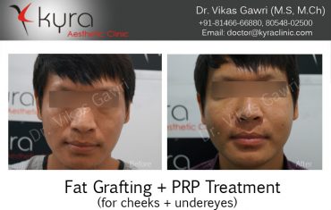 fat-grafting14