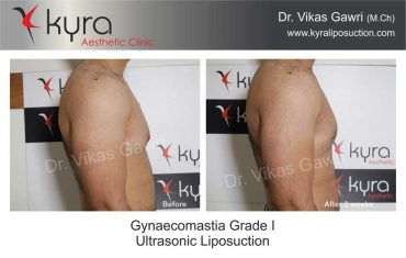 gynecomastia-grade-1-ultrasonic-liposuction-1