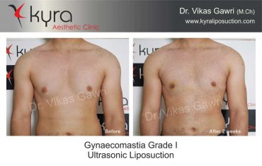 gynecomastia-grade-1-ultrasonic-liposuction-2