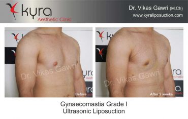 gynecomastia-grade-1-ultrasonic-liposuction-3