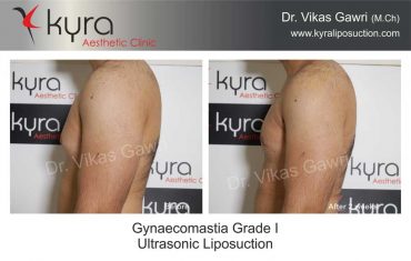 gynecomastia-grade-1-ultrasonic-liposuction-4