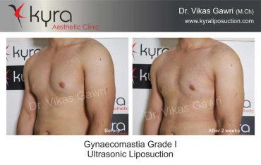 gynecomastia-grade-1-ultrasonic-liposuction-5