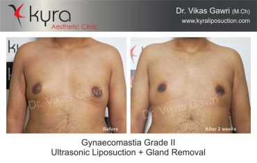 gynecomastia-grade-2-ultrasonic-liposuction-and-gland-removal-2