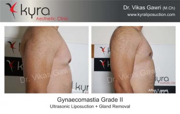 gynecomastia-india01-1