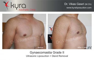 gynecomastia-india02-1