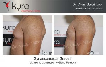 gynecomastia-india03-1