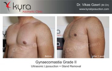 gynecomastia-india04-1