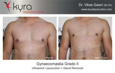 gynecomastia-india05-1