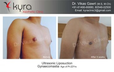gynecomastia-india16-1