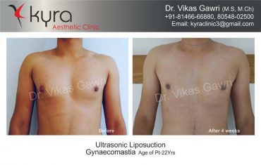 gynecomastia-india17-1