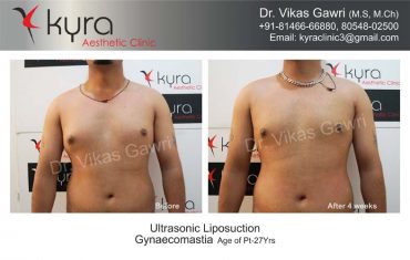 gynecomastia-india21-1