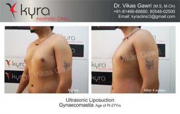 gynecomastia-india23-1