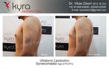 gynecomastia-india24-1