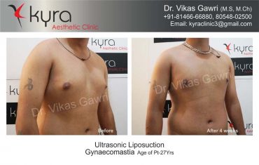 gynecomastia-india25-1