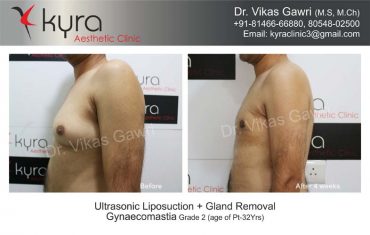 gynecomastia-india26-1