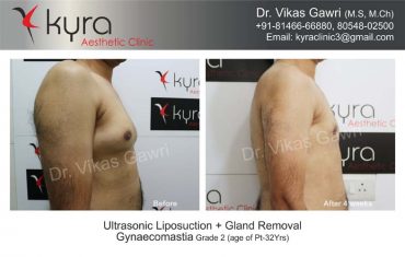 gynecomastia-india28-1