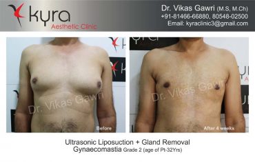 gynecomastia-india29-1