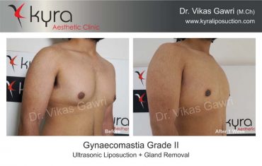 gynecomastia-india30-1
