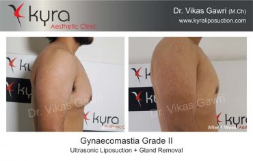 gynecomastia-india31-1