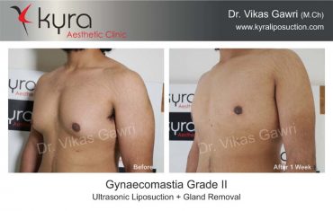 gynecomastia-india32-1