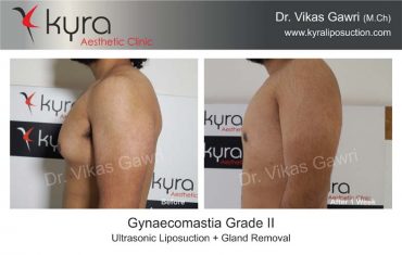 gynecomastia-india33-1