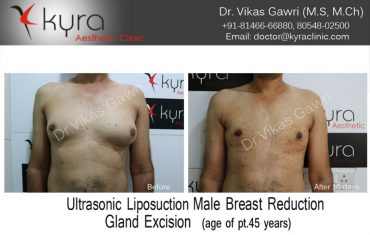 gyno15