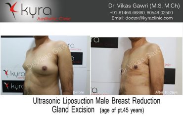 gyno18