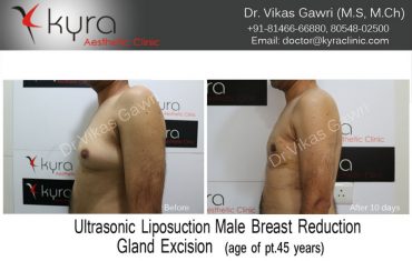 gyno19