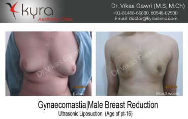 gyno2