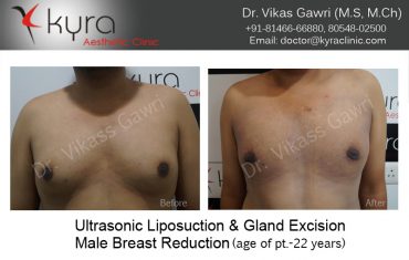 gyno20