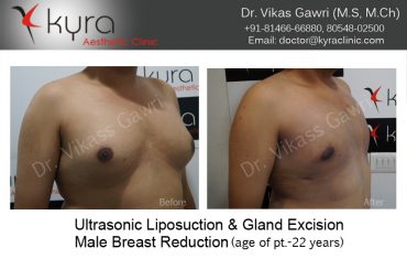 gyno21