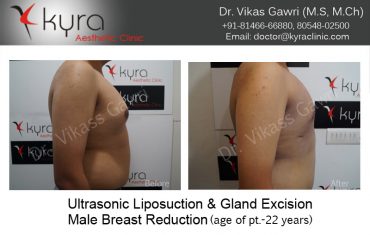 gyno22