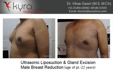gyno23