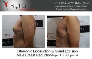 gyno24