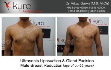 gyno25