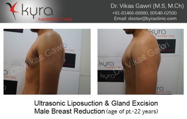 gyno26