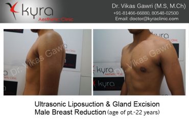 gyno27