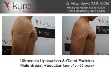 gyno28