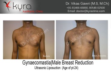 gyno3