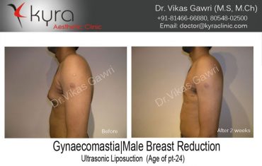 gyno4