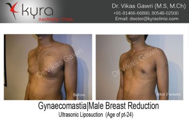 gyno5