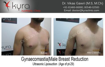 gyno6