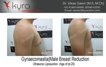 gyno7