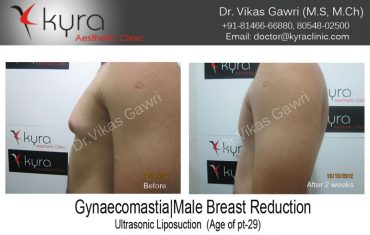 gyno8