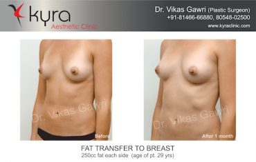 fat transfer to breast kyraclinic