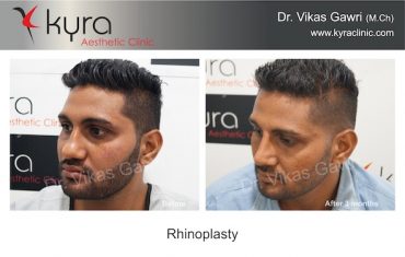 Rhinoplasty 6.2 Sukhpal