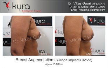 breast-implants-Amandeep Kaur 2