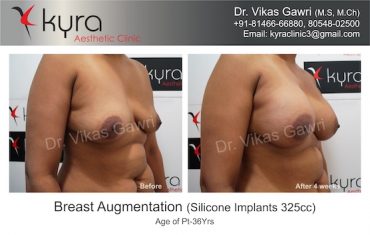 breast-implants-Amandeep Kaur 3