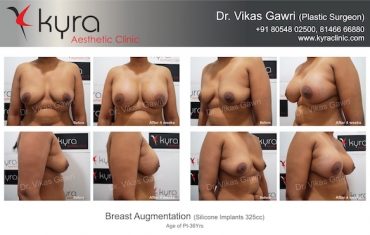 breast-implants-Amandeep Kaur Collage